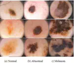 Skin Lesion Classification using Machine Learning Algorithms